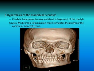 3.Hyperplasia of the mandibular condyle
– Condylar hyperplasia is a rare unilateral enlargement of the condyle
Causes: Mild chronic inflammation which stimulates the growth of the
condyle or adjacent tissue.
 