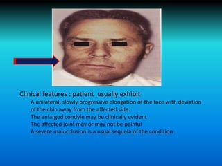 Clinical features : patient usually exhibit
A unilateral, slowly progressive elongation of the face with deviation
of the chin away from the affected side.
The enlarged condyle may be clinically evident
The affected joint may or may not be painful
A severe malocclusion is a usual sequela of the condition
 