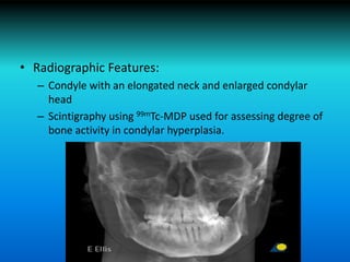 • Radiographic Features:
– Condyle with an elongated neck and enlarged condylar
head
– Scintigraphy using 99mTc-MDP used for assessing degree of
bone activity in condylar hyperplasia.
 