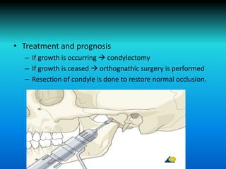 • Treatment and prognosis
– If growth is occurring  condylectomy
– If growth is ceased  orthognathic surgery is performed
– Resection of condyle is done to restore normal occlusion.
 