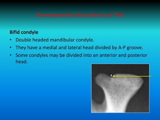 Developmental disturbance of TMJ
Bifid condyle
• Double headed mandibular condyle.
• They have a medial and lateral head divided by A-P groove.
• Some condyles may be divided into an anterior and posterior
head.
 