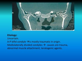 Etiology:
Uncertain.
A-P bifid condyle is mostly traumatic in origin.
Mediolaterally divided condyles  causes are trauma,
abnormal muscle attachment, teratogenic agents.
 