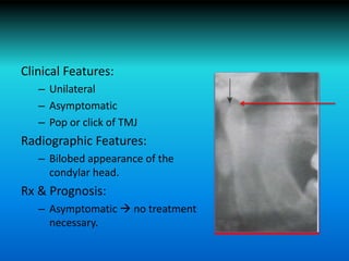 Clinical Features:
– Unilateral
– Asymptomatic
– Pop or click of TMJ
Radiographic Features:
– Bilobed appearance of the
condylar head.
Rx & Prognosis:
– Asymptomatic  no treatment
necessary.
 