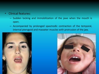 • Clinical features:
– Sudden locking and immobilization of the jaws when the mouth is
open.
– Accompanied by prolonged spasmodic contraction of the temporal,
internal pterygoid and masseter muscles with protrusion of the jaw.
 