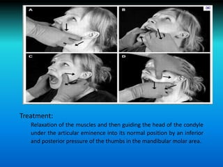 Treatment:
Relaxation of the muscles and then guiding the head of the condyle
under the articular eminence into its normal position by an inferior
and posterior pressure of the thumbs in the mandibular molar area.
 