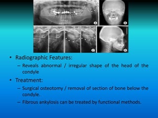 II. Traumatic disturbances of the TMJ
• Radiographic Features:
– Reveals abnormal / irregular shape of the head of the
condyle
• Treatment:
– Surgical osteotomy / removal of section of bone below the
condyle.
– Fibrous ankylosis can be treated by functional methods.
 