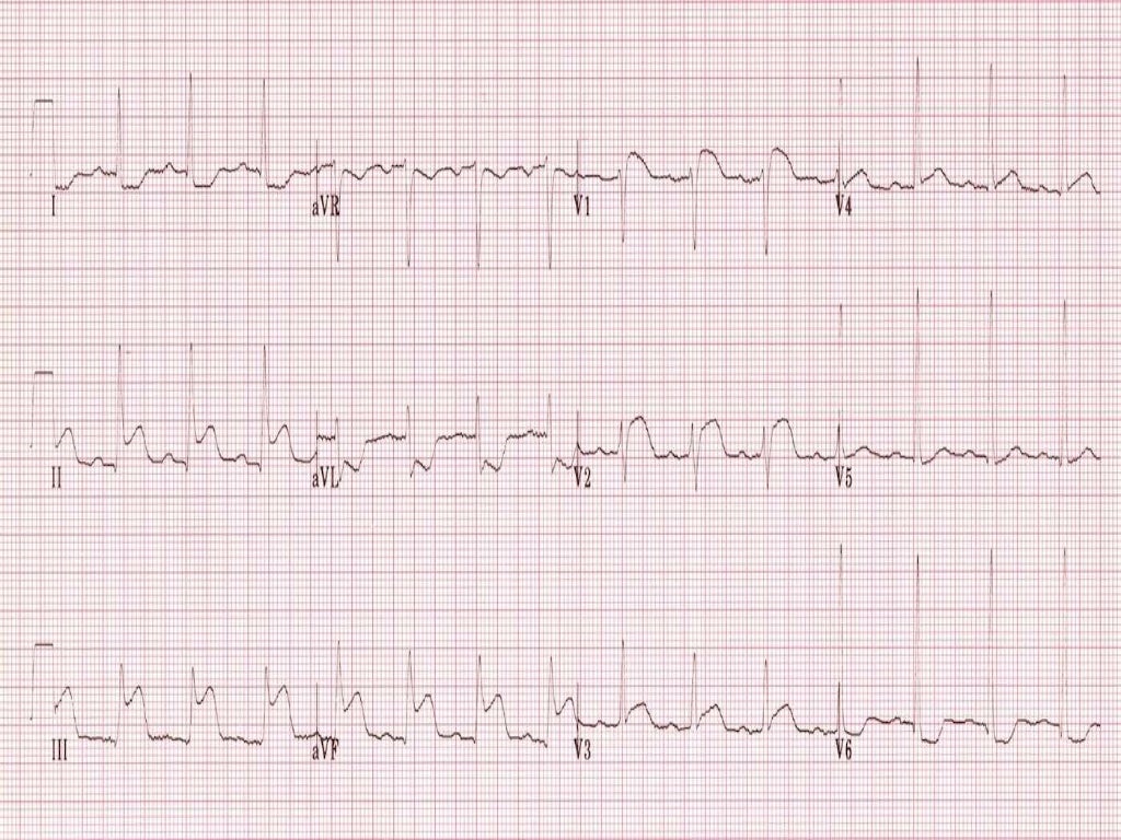 ECG LOCALISATION OF CULPRIT ARTERY IN STEMI