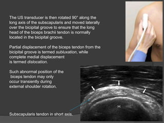 The US transducer is then rotated 90° along the
long axis of the subscapularis and moved laterally
over the bicipital groove to ensure that the long
head of the biceps brachii tendon is normally
located in the bicipital groove.
Partial displacement of the biceps tendon from the
bicipital groove is termed subluxation, while
complete medial displacement
is termed dislocation.
Such abnormal position of the
biceps tendon may only
occur transiently during
external shoulder rotation.
Subscapularis tendon in short axis.
 