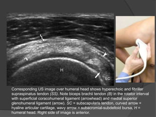 Corresponding US image over humeral head shows hyperechoic and fibrillar
supraspinatus tendon (SS). Note biceps brachii tendon (B) in the rotator interval
with superficial coracohumeral ligament (arrowhead) and medial superior
glenohumeral ligament (arrow). SC = subscapularis tendon, curved arrow =
hyaline articular cartilage, wavy arrow = subacromial-subdeltoid bursa, H =
humeral head. Right side of image is anterior.
 