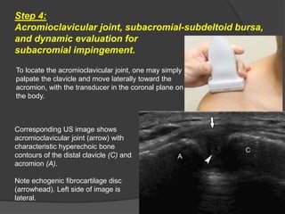 Step 4:
Acromioclavicular joint, subacromial-subdeltoid bursa,
and dynamic evaluation for
subacromial impingement.
To locate the acromioclavicular joint, one may simply
palpate the clavicle and move laterally toward the
acromion, with the transducer in the coronal plane on
the body.
Corresponding US image shows
acromioclavicular joint (arrow) with
characteristic hyperechoic bone
contours of the distal clavicle (C) and
acromion (A).
Note echogenic fibrocartilage disc
(arrowhead). Left side of image is
lateral.
 