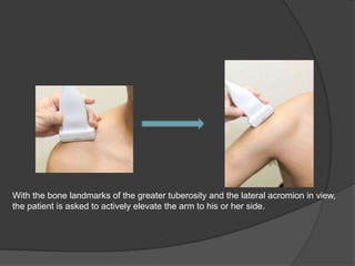 With the bone landmarks of the greater tuberosity and the lateral acromion in view,
the patient is asked to actively elevate the arm to his or her side.
 