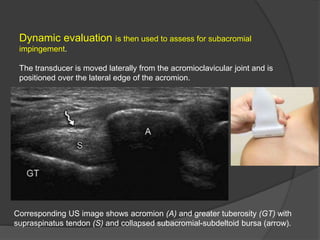 Dynamic evaluation is then used to assess for subacromial
impingement.
The transducer is moved laterally from the acromioclavicular joint and is
positioned over the lateral edge of the acromion.
Corresponding US image shows acromion (A) and greater tuberosity (GT) with
supraspinatus tendon (S) and collapsed subacromial-subdeltoid bursa (arrow).
 