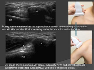 US image shows acromion (A), greater tuberosity (GT), and normal collapsed
subacromial-subdeltoid bursa (arrow). Left side of images is lateral.
During active arm elevation, the supraspinatus tendon and overlying subacromial-
subdeltoid bursa should slide smoothly under the acromion and out of view.
 