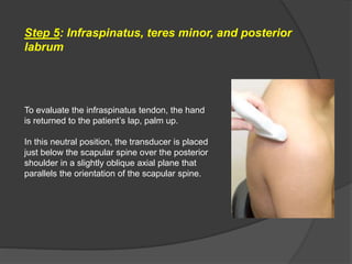 Step 5: Infraspinatus, teres minor, and posterior
labrum
To evaluate the infraspinatus tendon, the hand
is returned to the patient’s lap, palm up.
In this neutral position, the transducer is placed
just below the scapular spine over the posterior
shoulder in a slightly oblique axial plane that
parallels the orientation of the scapular spine.
 