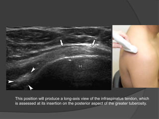 This position will produce a long-axis view of the infraspinatus tendon, which
is assessed at its insertion on the posterior aspect of the greater tuberosity.
 