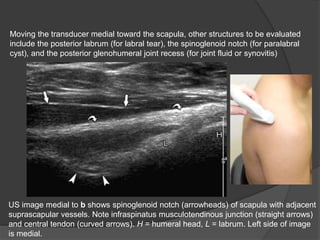 Moving the transducer medial toward the scapula, other structures to be evaluated
include the posterior labrum (for labral tear), the spinoglenoid notch (for paralabral
cyst), and the posterior glenohumeral joint recess (for joint fluid or synovitis)
US image medial to b shows spinoglenoid notch (arrowheads) of scapula with adjacent
suprascapular vessels. Note infraspinatus musculotendinous junction (straight arrows)
and central tendon (curved arrows). H = humeral head, L = labrum. Left side of image
is medial.
 