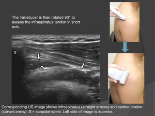 The transducer is then rotated 90° to
assess the infraspinatus tendon in short
axis.
Corresponding US image shows infraspinatus (straight arrows) and central tendon
(curved arrow). S = scapular spine. Left side of image is superior.
 