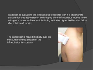 In addition to evaluating the infraspinatus tendon for tear, it is important to
evaluate for fatty degeneration and atrophy of the infraspinatus muscle in the
setting of a rotator cuff tear as this finding indicates higher likelihood of failure
after rotator cuff repair.
The transducer is moved medially over the
musculotendinous junction of the
infraspinatus in short axis.
 