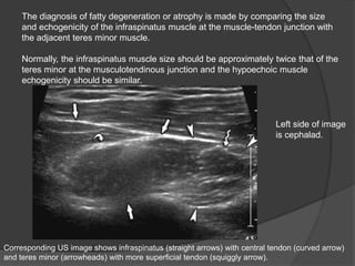 The diagnosis of fatty degeneration or atrophy is made by comparing the size
and echogenicity of the infraspinatus muscle at the muscle-tendon junction with
the adjacent teres minor muscle.
Normally, the infraspinatus muscle size should be approximately twice that of the
teres minor at the musculotendinous junction and the hypoechoic muscle
echogenicity should be similar.
Corresponding US image shows infraspinatus (straight arrows) with central tendon (curved arrow)
and teres minor (arrowheads) with more superficial tendon (squiggly arrow).
Left side of image
is cephalad.
 