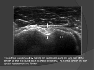 This artifact is eliminated by making the transducer along the long axis of the
tendon so that the sound beam is angled superiorly. The normal tendon will then
appear hyperechoic and fibrillar.
 