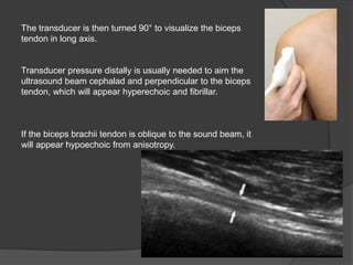 The transducer is then turned 90° to visualize the biceps
tendon in long axis.
Transducer pressure distally is usually needed to aim the
ultrasound beam cephalad and perpendicular to the biceps
tendon, which will appear hyperechoic and fibrillar.
If the biceps brachii tendon is oblique to the sound beam, it
will appear hypoechoic from anisotropy.
 