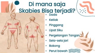 Di mana saja
Skabies Bisa terjadi?
• Dada
• Ketiak
• Pinggang
• Lipat Siku
• Pergelangan Tangan
• Sela-sela jari
• Bokong
• Perut bawah
 