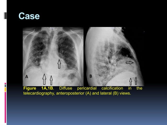 The difficulty of coronary artery bypass grafting in a patient with ...