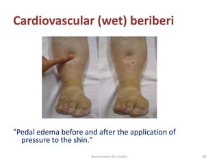 Cardiovascular (wet) beriberi
"Pedal edema before and after the application of
pressure to the shin."
28Biochemistry for medics
 