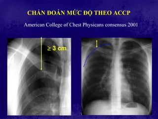 CHẨN ĐOÁN MỨC ĐỘ THEO ACCP
American College of Chest Physicans consensus 2001
 3 cm
 