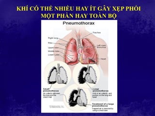 KHÍ CÓ THỂ NHIỀU HAY ÍT GÂY XẸP PHỔI
MỘT PHẦN HAY TOÀN BỘ
 