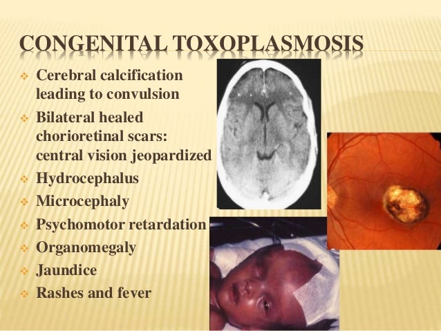 Herpes Zoster Picture Image on MedicineNet.com