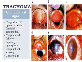 Conjunctival
signs:
• Congestion of
upper tarsal and
fornicial
conjunctiva
• Conjunctival
follicles
• Papillary
hyperplasia
• Conjunctival
scarring
• Concretions
TRACHOMA
 