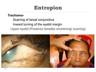 Entropion
Trachoma-
Scarring of tarsal conjunctiva
Inward turning of the eyelid margin
Upper eyelid (Posterior lamellar shortening/ scarring)
 