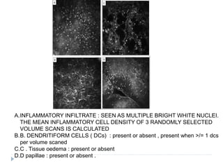 A.INFLAMMATORY INFILTRATE : SEEN AS MULTIPLE BRIGHT WHITE NUCLEI.
THE MEAN INFLAMMATORY CELL DENSITY OF 3 RANDOMLY SELECTED
VOLUME SCANS IS CALCULATED
B.B. DENDRITIFORM CELLS ( DCs) : present or absent , present when >/= 1 dcs
per volume scaned
C.C . Tissue oedema : present or absent
D.D papillae : present or absent .
 