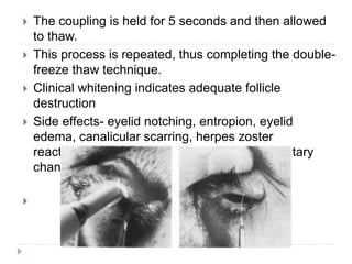  The coupling is held for 5 seconds and then allowed
to thaw.
 This process is repeated, thus completing the double-
freeze thaw technique.
 Clinical whitening indicates adequate follicle
destruction
 Side effects- eyelid notching, entropion, eyelid
edema, canalicular scarring, herpes zoster
reactivation, symblepharon and eyelid pigmentary
changes.

 