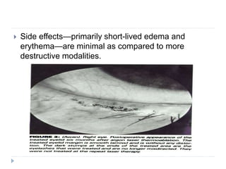  Side effects—primarily short-lived edema and
erythema—are minimal as compared to more
destructive modalities.
 