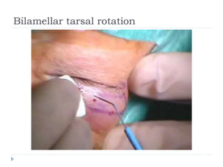 Bilamellar tarsal rotation
 