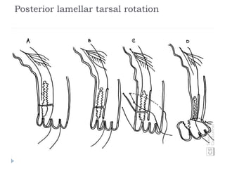 Posterior lamellar tarsal rotation
 