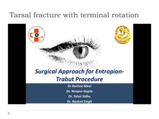 Tarsal fracture with terminal rotation
 