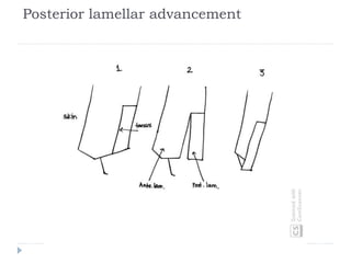 Posterior lamellar advancement
 