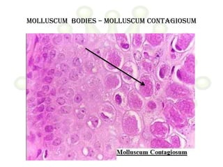 Molluscum bodies – molluscum contagiosum
 