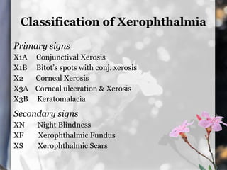 Classification of Xerophthalmia

Primary signs
X1A Conjunctival Xerosis
X1B Bitot’s spots with conj. xerosis
X2  Corneal Xerosis
X3A Corneal ulceration & Xerosis
X3B Keratomalacia

Secondary signs
XN    Night Blindness
XF    Xerophthalmic Fundus
XS    Xerophthalmic Scars
 