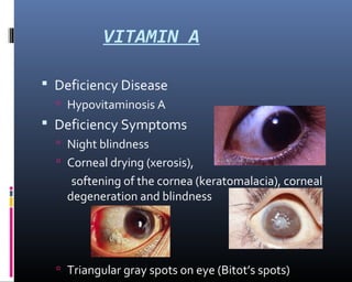 VITAMIN A
 Deficiency Disease
 Hypovitaminosis A
 Deficiency Symptoms
 Night blindness
 Corneal drying (xerosis),
softening of the cornea (keratomalacia), corneal
degeneration and blindness
 Triangular gray spots on eye (Bitot’s spots)
 