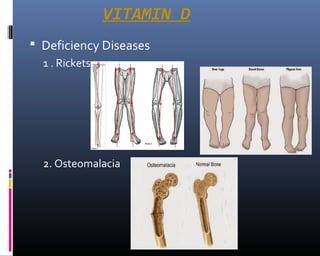 VITAMIN D
 Deficiency Diseases
1 . Rickets
2. Osteomalacia
 