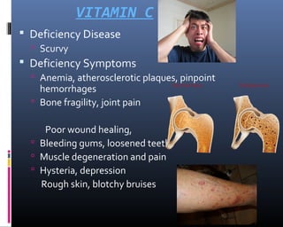 VITAMIN C
 Deficiency Disease
 Scurvy
 Deficiency Symptoms
 Anemia, atherosclerotic plaques, pinpoint
hemorrhages
 Bone fragility, joint pain
Poor wound healing,
 Bleeding gums, loosened teeth
 Muscle degeneration and pain
 Hysteria, depression
Rough skin, blotchy bruises
 