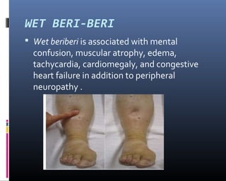 WET BERI-BERI
 Wet beriberi is associated with mental
confusion, muscular atrophy, edema,
tachycardia, cardiomegaly, and congestive
heart failure in addition to peripheral
neuropathy .
 