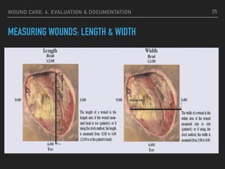 WOUND CARE: 4. EVALUATION & DOCUMENTATION
MEASURING WOUNDS: LENGTH & WIDTH
25
 