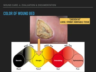 WOUND CARE: 4. EVALUATION & DOCUMENTATION
COLOR OF WOUND BED
“CHICKEN FAT”
LOOSE, STRINGY, NONVIABLE TISSUE
 