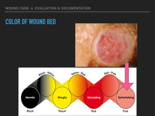 WOUND CARE: 4. EVALUATION & DOCUMENTATION
COLOR OF WOUND BED
 