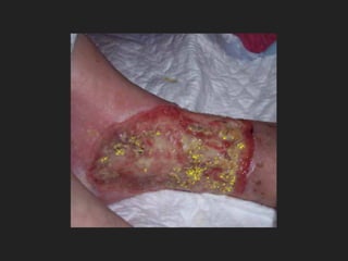 Wound care 